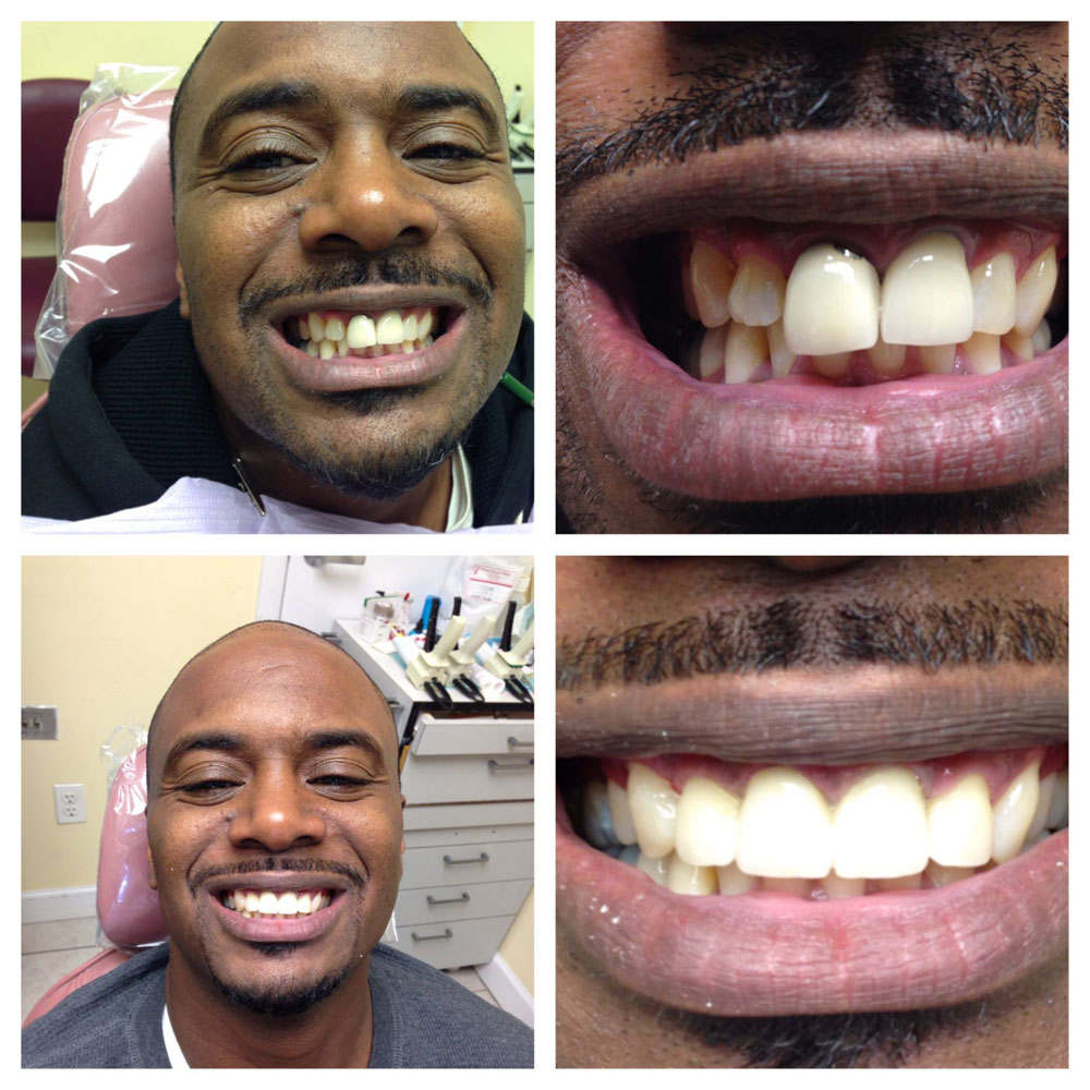 Cosmetic-Dentistry-Makeover-Before-After