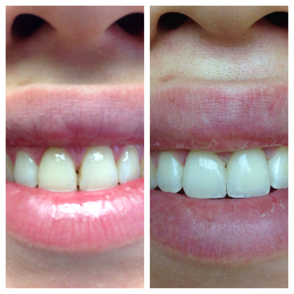 Porcelain-Laminates-Before-After-Photos-2