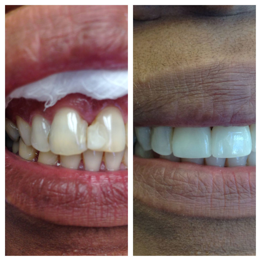 Porcelain-Laminates-Before-After-Photos-5