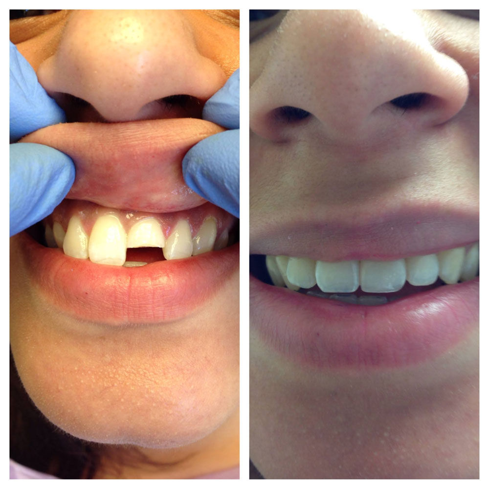 Emergency-Cosmetic-Dentistry-Before-After
