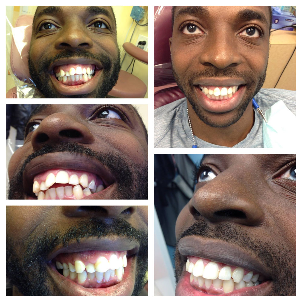 Invisalign-Before-After-Photos2